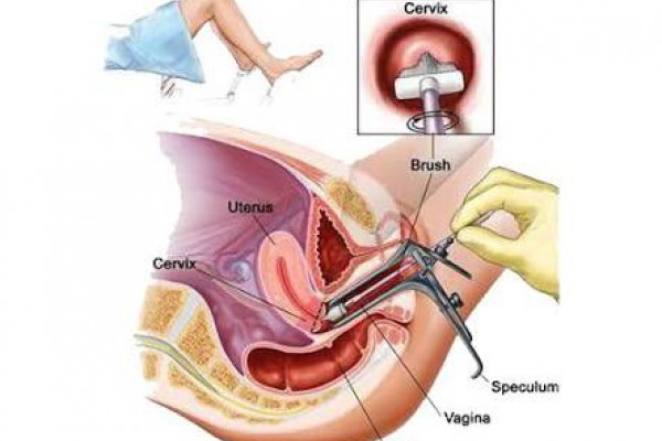 Dinkes ambon ajak kaum perempuan tes IVA