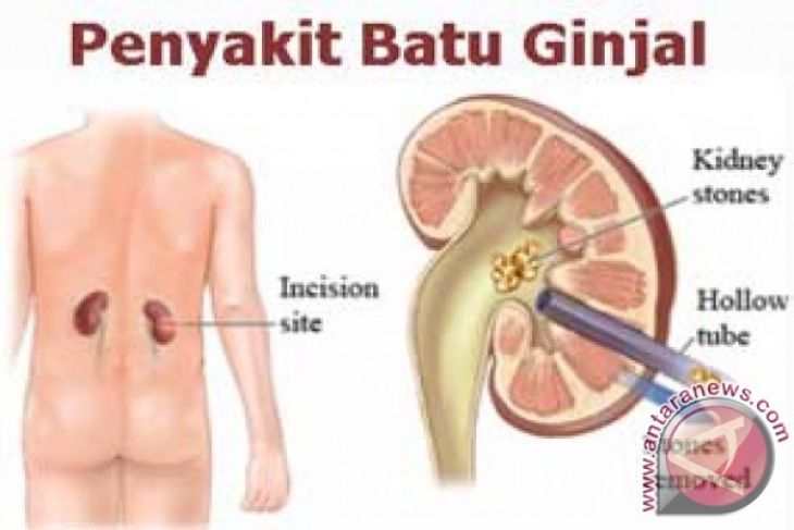Batu Ginjal Kerap Diderita Pada Usia Produktif - ANTARA Batu Ginjal Kerap Diderita Pada Usia Produktif - ANTARA