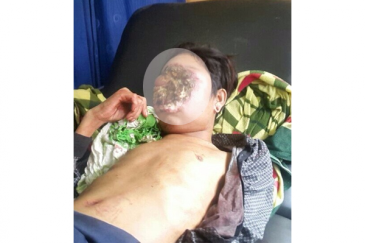 Setelah Tindik Hidung, Wajah Tatuit Rusak