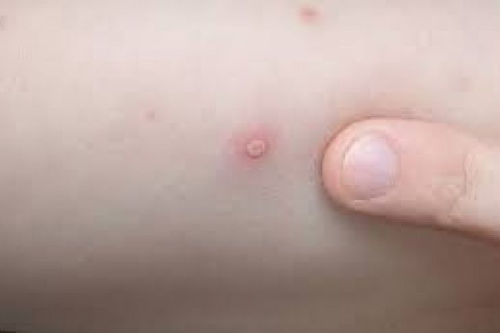 14 Santri di Banjar terserang Rubella