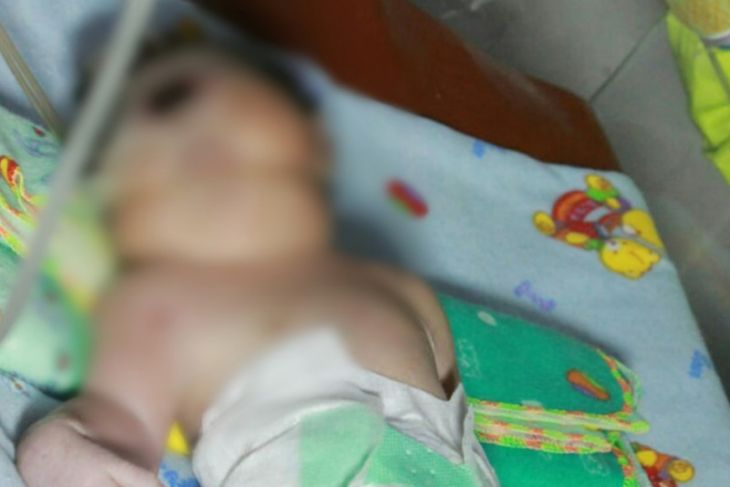 Bayi bermata satu lahir di Panyabungan